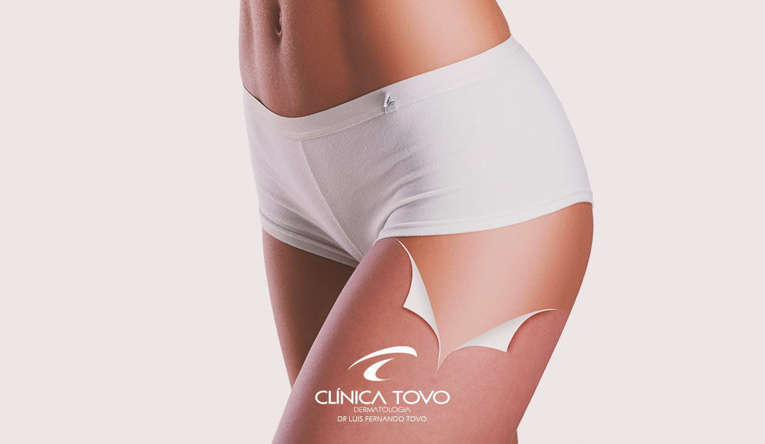 Existe Solução para Celulite? – Reportagem do Fantástico