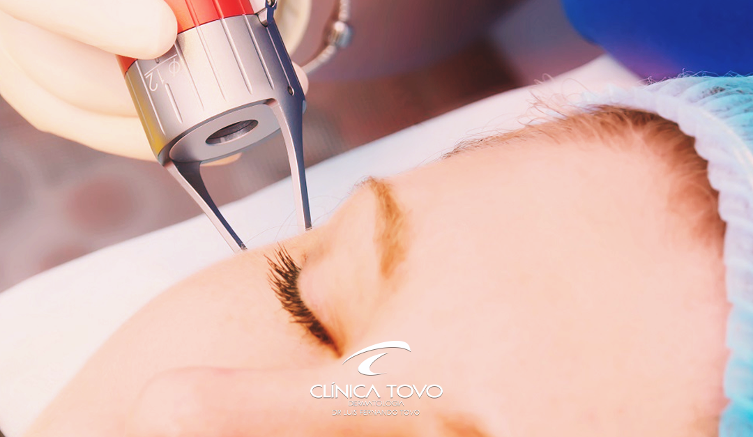 O que é o laser fracionado