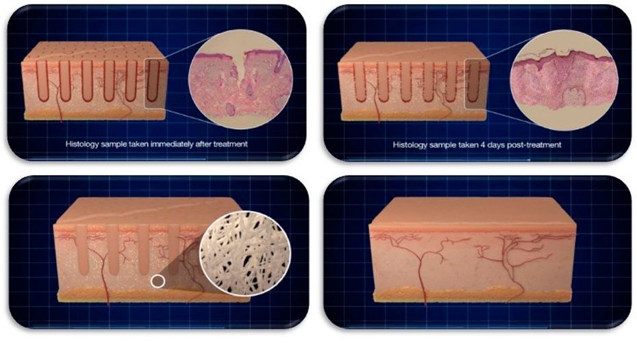 laser fracionado clinica tovo dermatologia