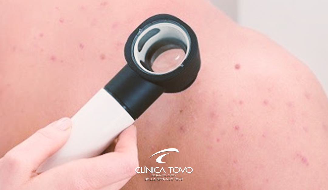 5.400.000 Casos de Câncer de Pele NÃO MELANOMA ao Ano Nos USA