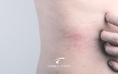 Dermatite Atópica – Nova Droga para Controle