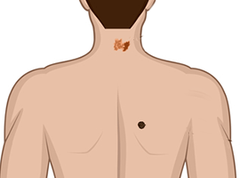 melanoma texto alternativo