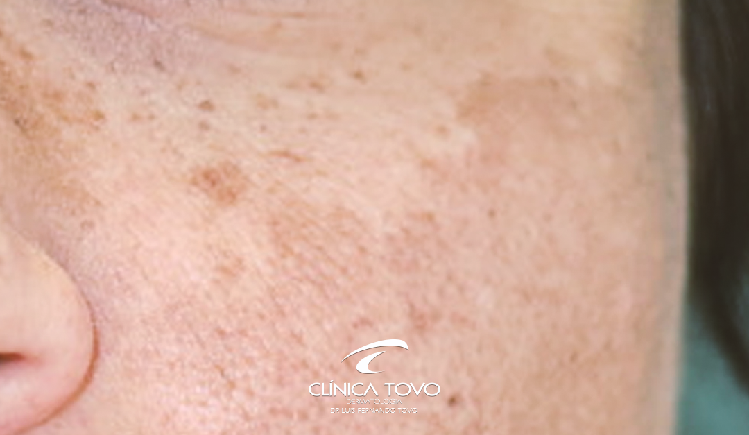 Novidades em Dermatologia Meeting AAD Fevereiro 2018 Melasma