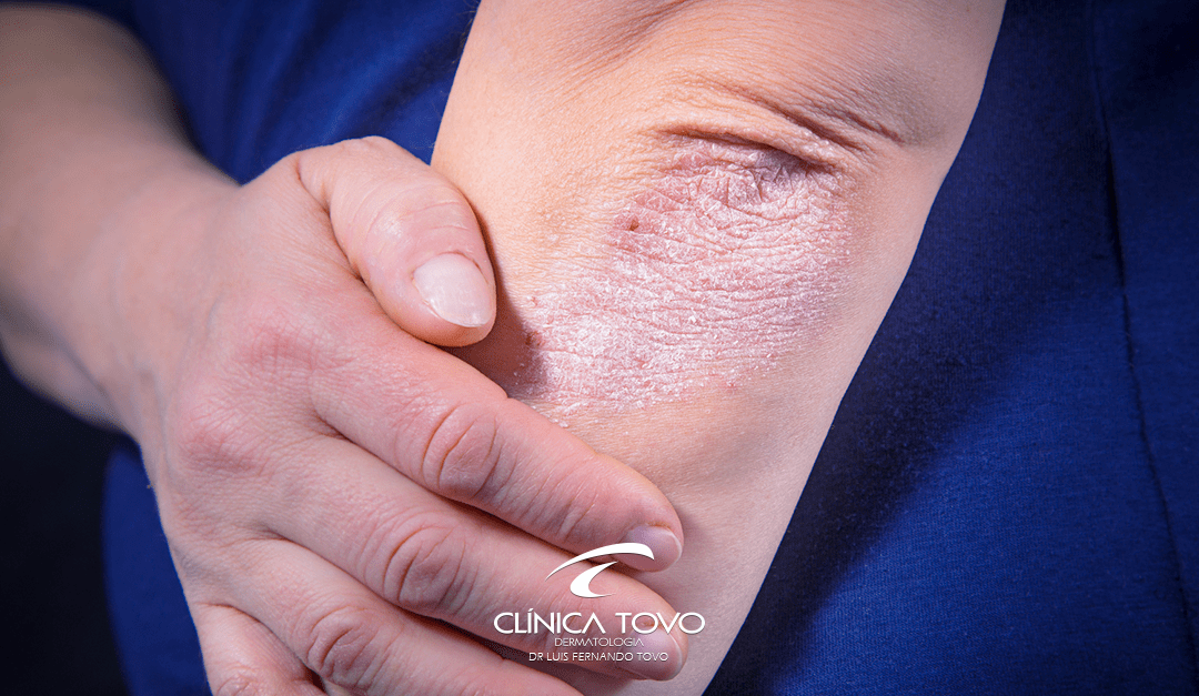 Tratamento de Dermatite Atópica com Dupilumab – Um Recente Avanço na Dermatologia