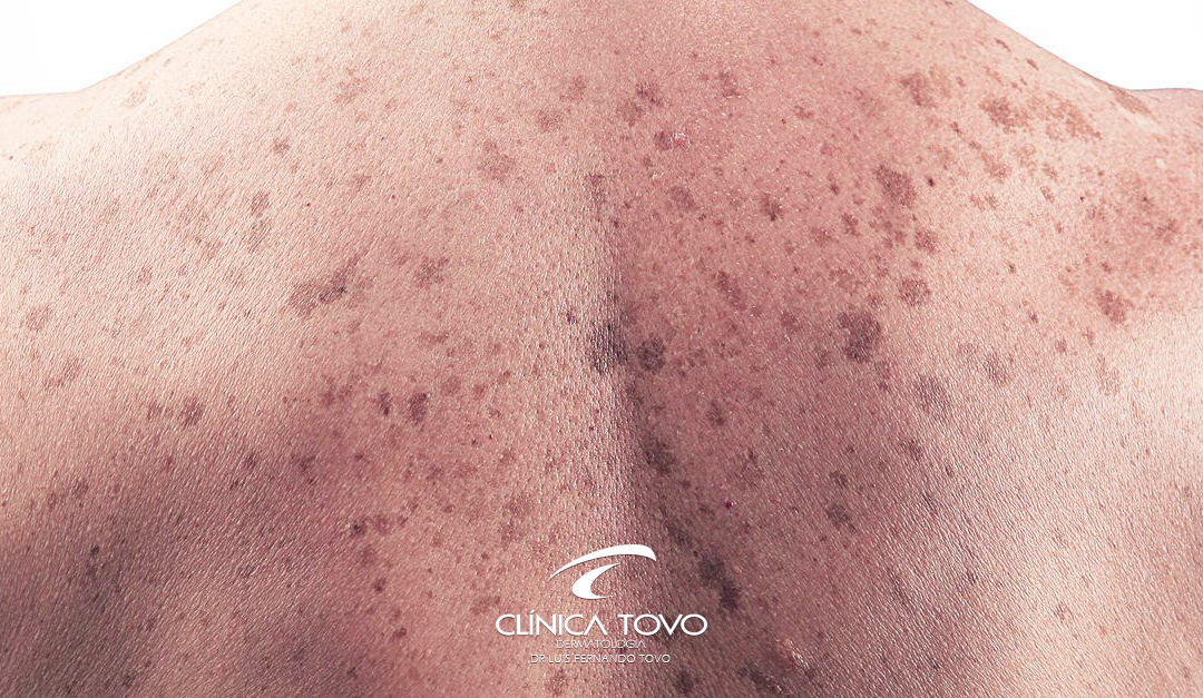 Câncer da Pele das Células de Merkel – Entenda este tipo raro de Carcinoma