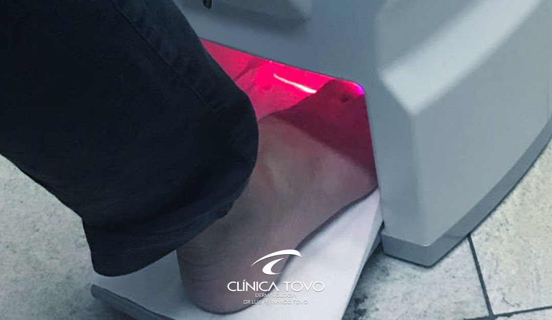 Micose de Unha – Inovação no Tratamento – Clinica Tovo Dermatologia dr Tovo LUIS FERNANDO TOVO