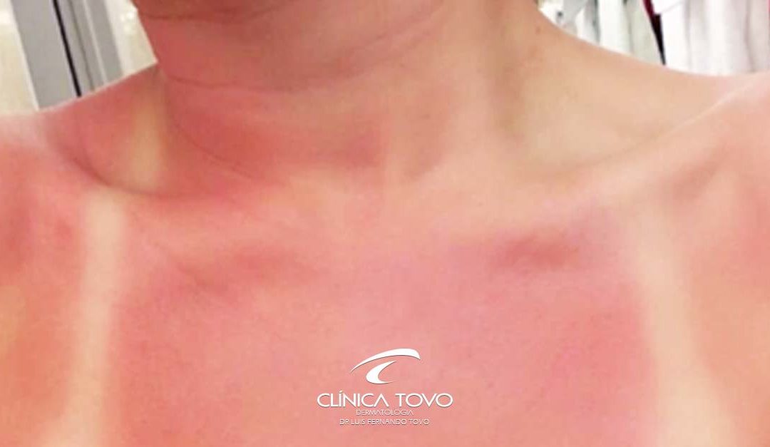 Você Conhece os Sinais da Pele Danificada Pelo Sol?