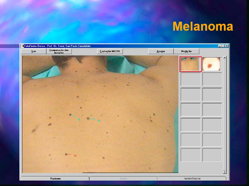 mitos e verdades cancer da pele