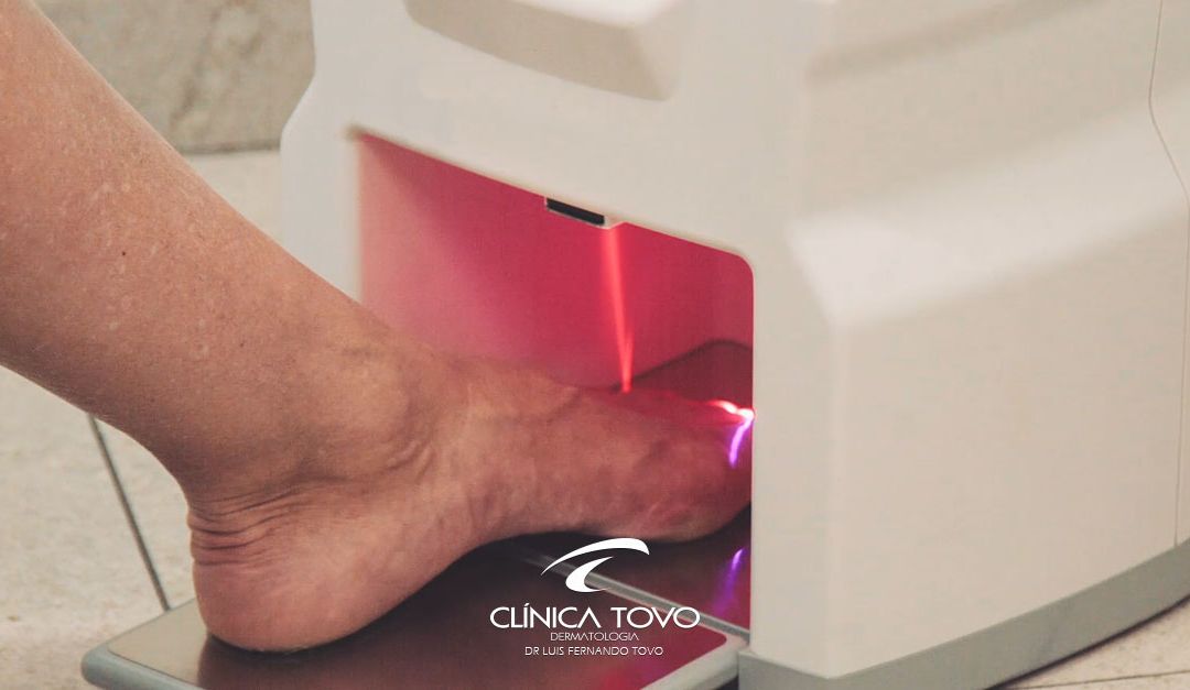 Clínica Tovo Luis Fernando Tovo – Dr. Tovo Fala Sobre o Tratamento de Unha com Tecnologia