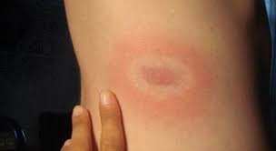 Doença de Lyme – Justin Bieber diagnóstico.