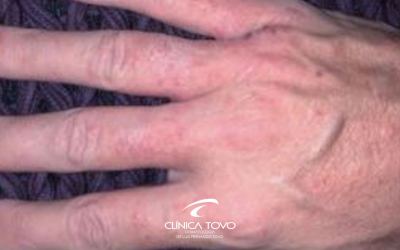 DERMATITE DE MÃOS em tempos de Quarentena COVID-19.
