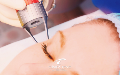 Laser Fracionado Funciona para Marcas de Acne e Cicatrizes?
