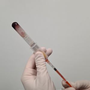 CLINICA TOVO PLASMA RICO EM PLAQUETAS