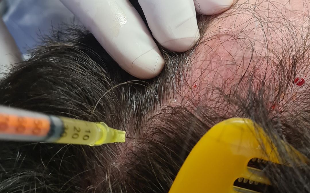 tovo dermato plasma rico em plaquetas