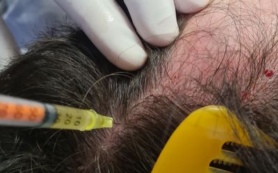 Plasma Rico em Plaquetas no tratamento da calvície