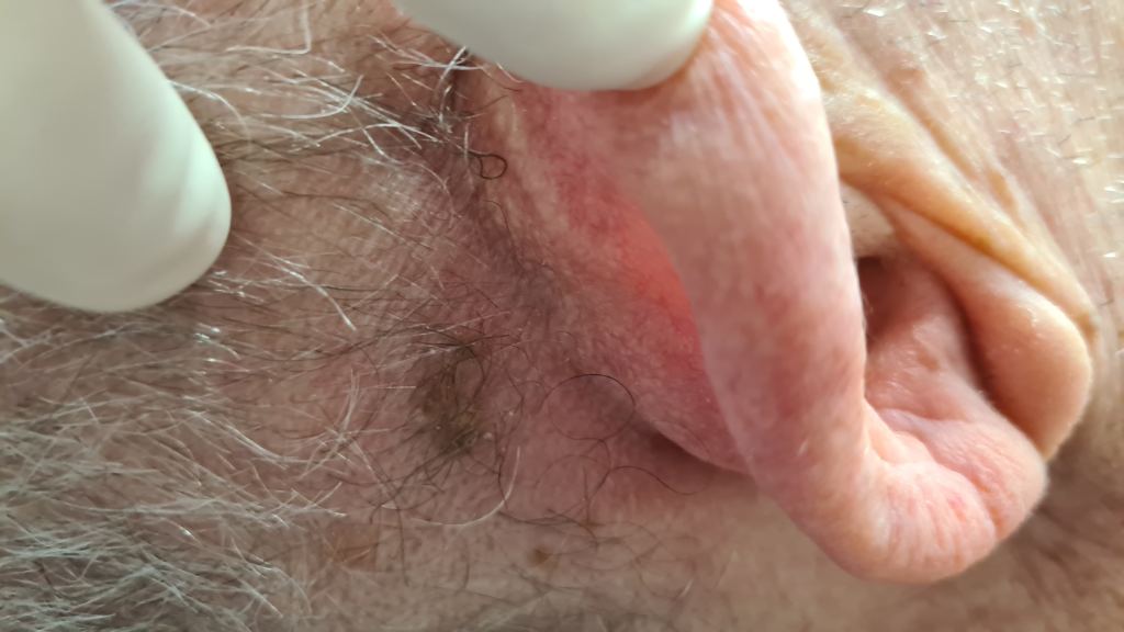 tovo dermatologista cancer da pele