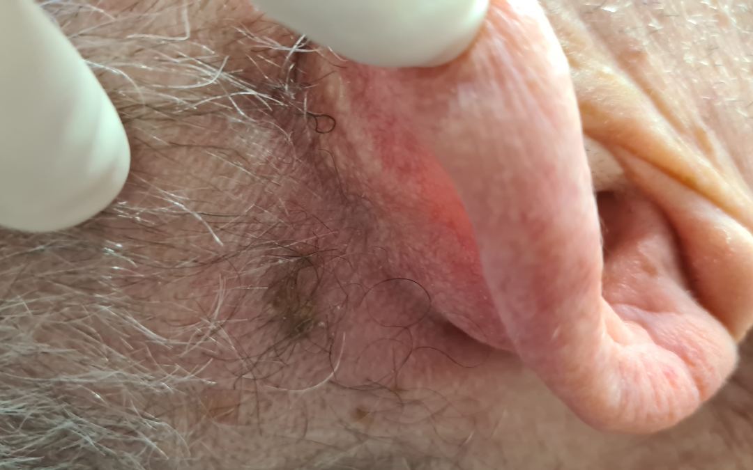 CÂNCER DA PELE: mitos e verdades